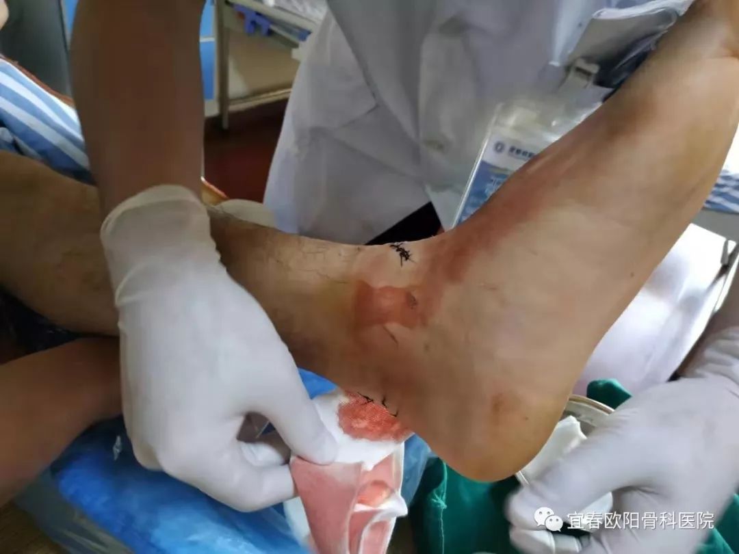 少年腳跟被玻璃割裂，手足外科醫(yī)師緊急手術