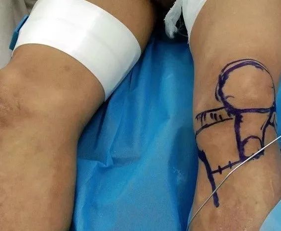 我院保膝治療又獲成功，關節(jié)病患者的福音！