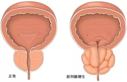 前列腺增生，尿頻、尿急怎么辦？等離子電切術(shù)治愈！